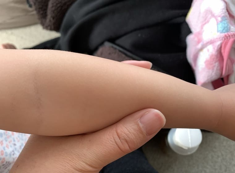 パイナップル豆乳ローションプレミアムを子供の腕に塗った写真